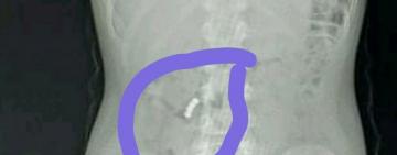 В Одесской области ребенок наглотался магнитов: нужна ваша помощь