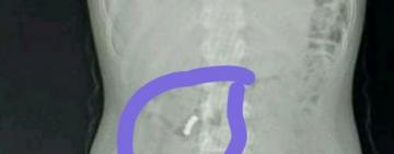  Чудом спасли: школьница из Одесской области, которая проглотила магниты, до сих пор в реанимации