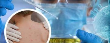 УКРАЇНА ОТРИМАЛА 10 ТИС ДОЗ ВАКЦИНИ ВІД ВІСПИ МАВП – МОЗ