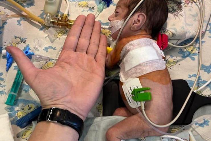 Одеські лікарі прооперували дитинку з критично малою вагою