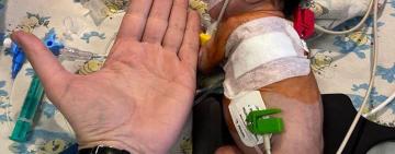 Одеські лікарі прооперували дитинку з критично малою вагою