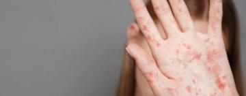 В Україні зареєстровані випадки небезпечного інфекційного захворювання – МОЗ