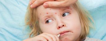 В Одесі 3-річна і 8-річна дитини захворіли на кір