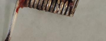 Лікарі Одеської обласної лікарні врятували 6-місячну дитину, у стравоході якої була пружина