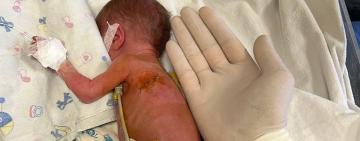 Шанс на повноцінне життя 900-грамовому малюку подарували одеські лікарі