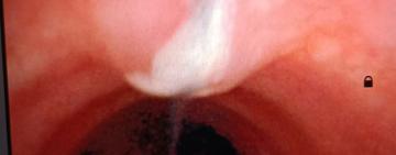 Ювелірна робота медиків: на Одещині підліток проковтнув голку