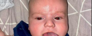 Хлопчик з Одеси народився з аномально великим язиком – лікарі провели унікальну операцію