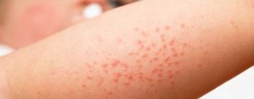 В Одеській області спостерігається зростання захворюваності на скарлатину