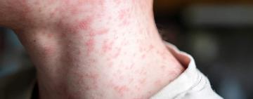 В Одеській області зареєстрували чотири випадки кору: діти не були вакциновані