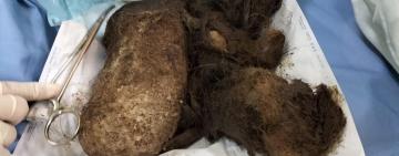 Кілограм волосся у шлунку: львівські лікарі врятували 15-річну дівчинку від рідкісної патології