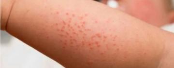 На Одещині зафіксували летальний випадок від ускладнень, спричинених кором - у лікарні померла 9-місячна дитина