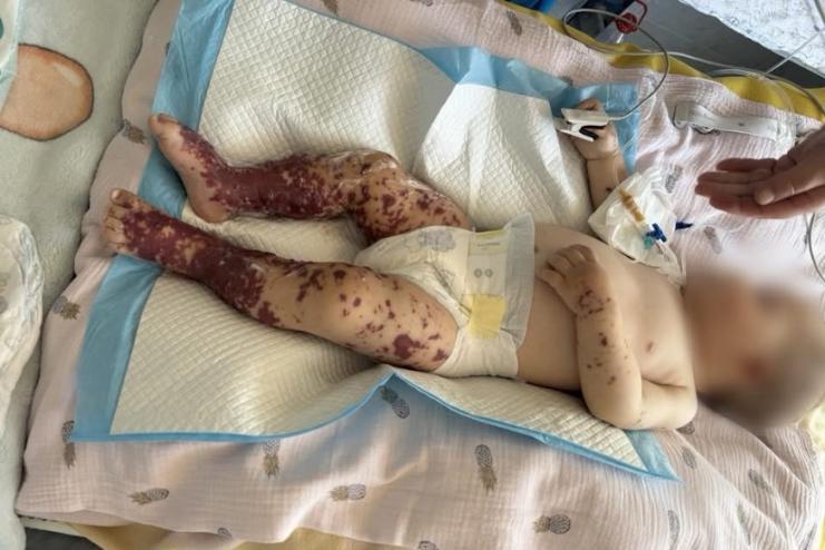 Лікарське диво: у Чернівцях лікарі врятували немовля з критичною формою менінгококової інфекції