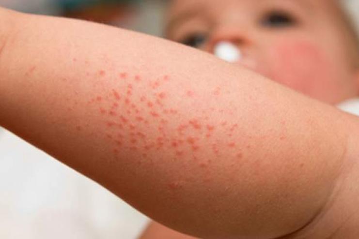 У Болградському районі зафіксували випадок скарлатини у дитини