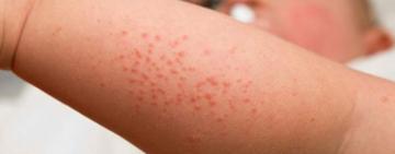 У Болградському районі зафіксували випадок скарлатини у дитини