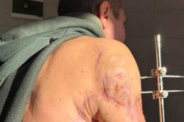 В Одесі лікарі врятували руку пораненому військовому, застосувавши сучасні технології