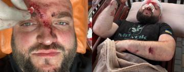 Побиття ветерана АТО через російську музику в Затоці: поліція відкрила справу, нападником виявився житель Подільська